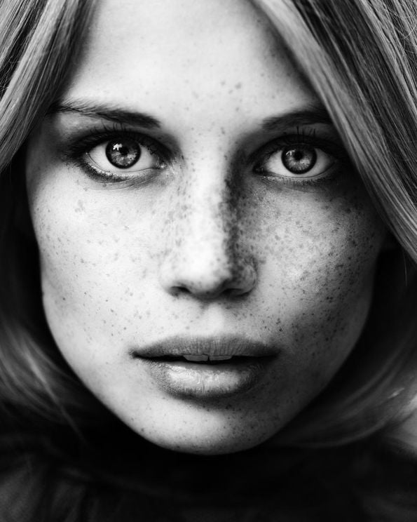 Freckles