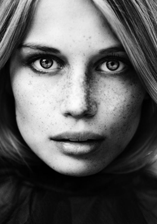Freckles